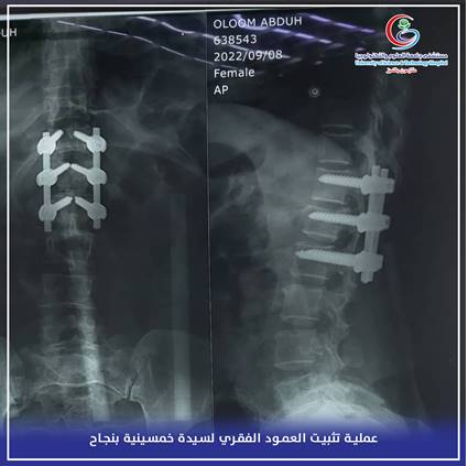 إثر سقوطها من منحدر جبلي.. إجراء عملية تثبيت العمود الفقري لسيدة خمسينية بنجاح